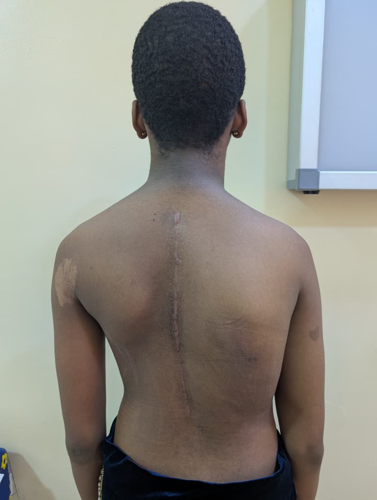 After: Posterior Spinal Instrumentation for Scoliosis